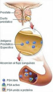 CancerdeProstata2