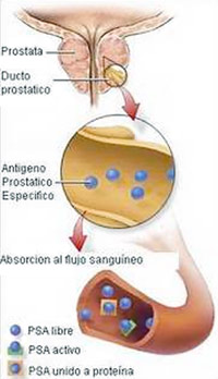 diagnostico cancer de prostata)