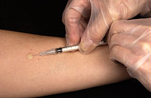 220px-Mantoux_tuberculin_skin_test